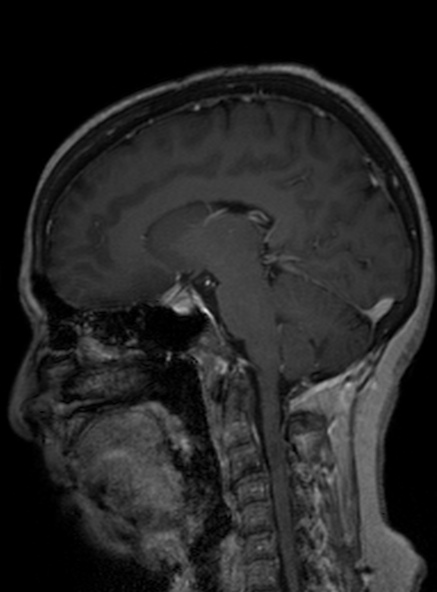 Clival meningioma (Radiopaedia 53278-59248 Sagittal T1 C+ 242).jpg