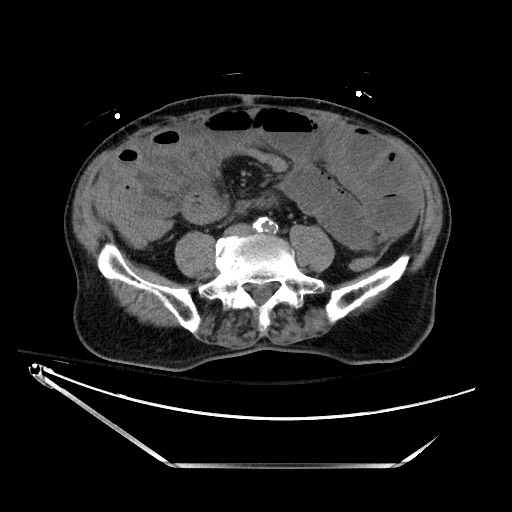 File:Closed loop obstruction due to adhesive band, resulting in small bowel ischemia and resection (Radiopaedia 83835-99023 Axial 11).jpg