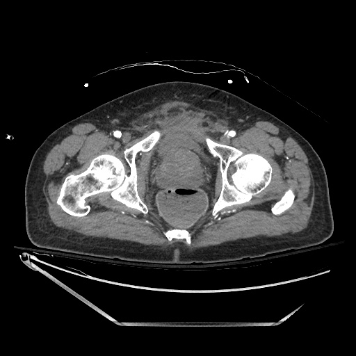 File:Closed loop obstruction due to adhesive band, resulting in small bowel ischemia and resection (Radiopaedia 83835-99023 Axial 280).jpg