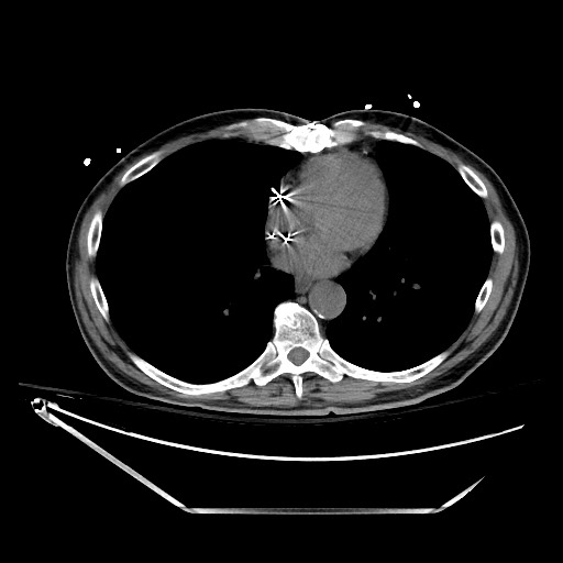 File:Closed loop obstruction due to adhesive band, resulting in small bowel ischemia and resection (Radiopaedia 83835-99023 Axial non-contrast 8).jpg
