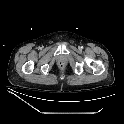 File:Closed loop obstruction due to adhesive band, resulting in small bowel ischemia and resection (Radiopaedia 83835-99023 D 159).jpg