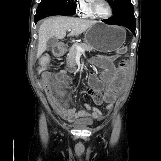 Closed loop obstruction due to adhesive band, resulting in small bowel ischemia and resection (Radiopaedia 83835-99023 E 49).jpg