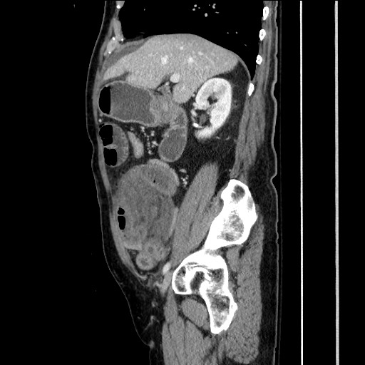 File:Closed loop obstruction due to adhesive band, resulting in small bowel ischemia and resection (Radiopaedia 83835-99023 F 68).jpg