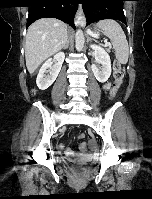 Closed loop small bowel obstruction - adhesions (Radiopaedia 59078-66369 B 77).jpg