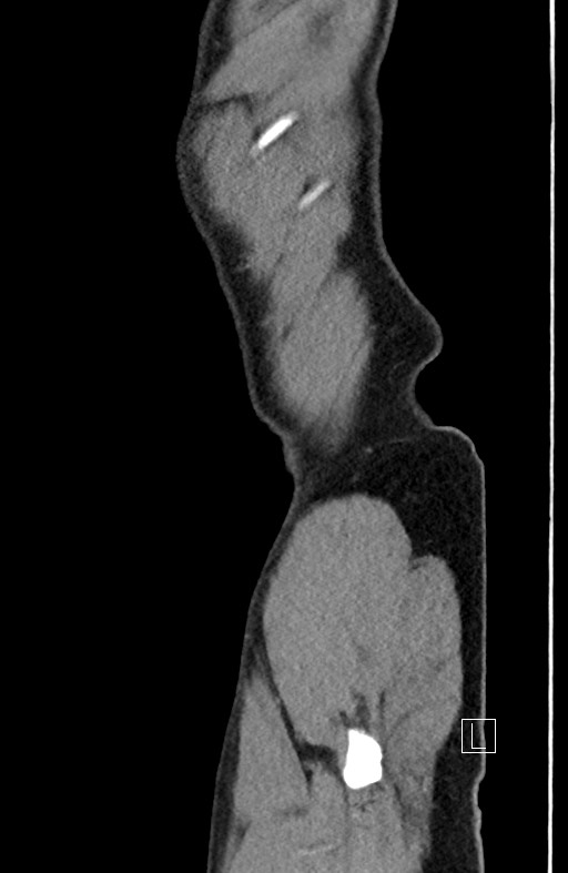 Closed loop small bowel obstruction - internal hernia (Radiopaedia 57806-64778 C 8).jpg