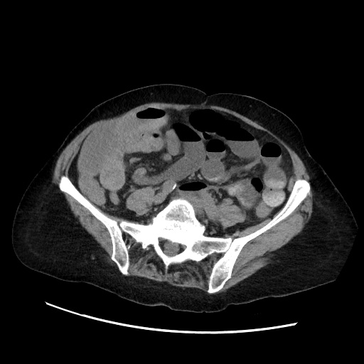 Closed loop small bowel obstruction due to adhesive band, with intramural hemorrhage and ischemia (Radiopaedia 83831-99017 Axial non-contrast 105).jpg