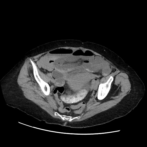 Closed loop small bowel obstruction due to adhesive band, with intramural hemorrhage and ischemia (Radiopaedia 83831-99017 Axial non-contrast 131).jpg