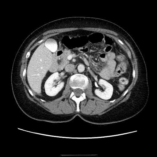 Closed loop small bowel obstruction due to adhesive bands - early and late images (Radiopaedia 83830-99015 A 58).jpg