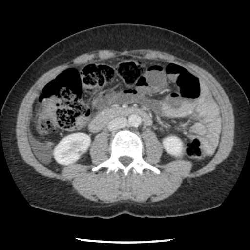 File:Closed loop small bowel obstruction due to trans-omental herniation (Radiopaedia 35593-37109 A 44).jpg