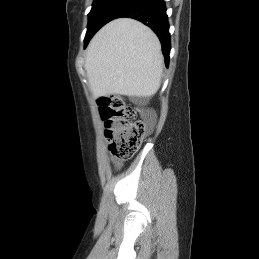 Closed loop small bowel obstruction due to trans-omental herniation (Radiopaedia 35593-37109 C 13).jpg