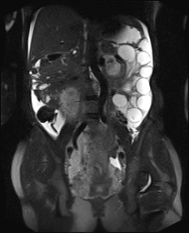 File:Closed loop small bowel obstruction in pregnancy (MRI) (Radiopaedia 87637-104031 Coronal T2 fat sat 34).jpg
