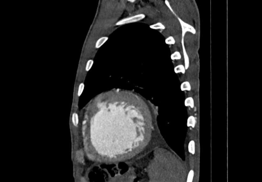 Coarctation of aorta with aortic valve stenosis (Radiopaedia 70463-80574 B 192).jpg