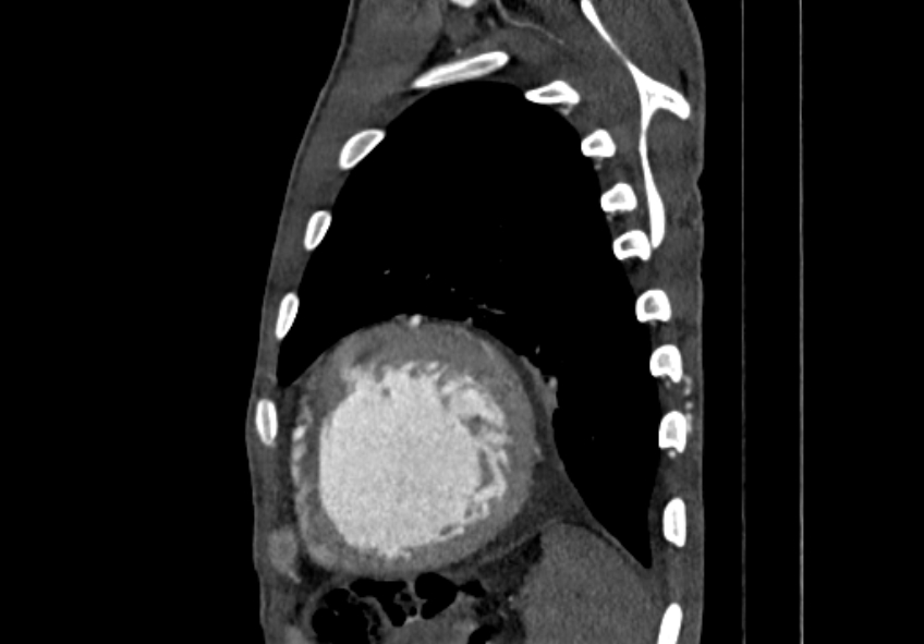 Coarctation of aorta with aortic valve stenosis (Radiopaedia 70463-80574 B 193).jpg