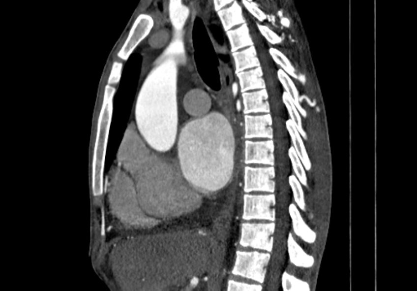 Coarctation of aorta with aortic valve stenosis (Radiopaedia 70463-80574 B 48).jpg