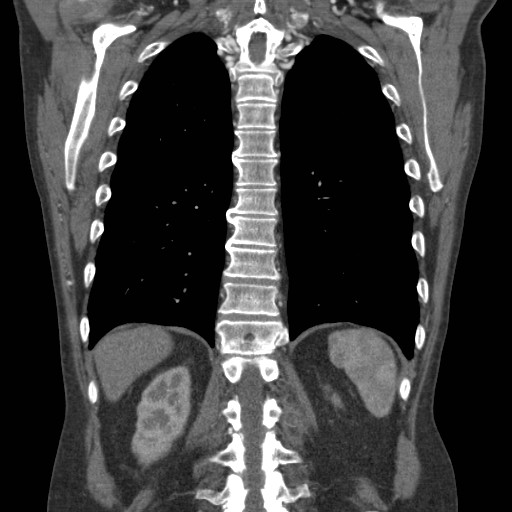 File:Coarctation of the aorta (Radiopaedia 17427-17116 A 26).jpg