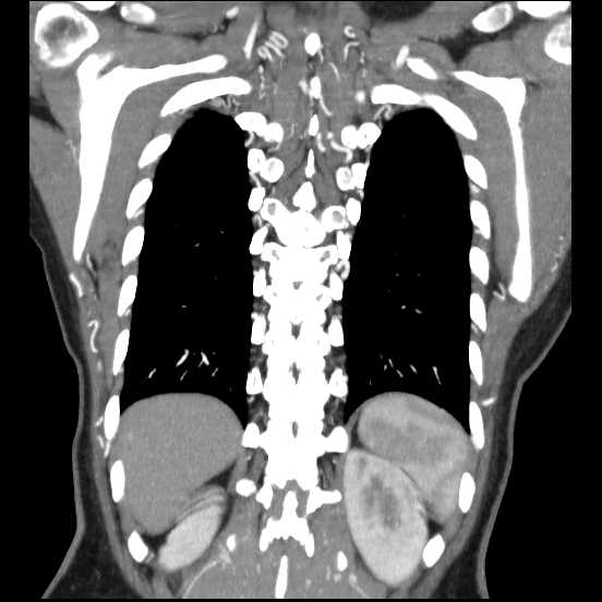 Coarctation of the aorta (Radiopaedia 67609-77010 B 14).jpg