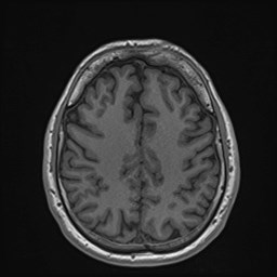File:Cochlear incomplete partition type III associated with hypothalamic hamartoma (Radiopaedia 88756-105498 Axial T1 138).jpg