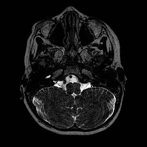File:Cochlear nerve aplasia - unilateral (Radiopaedia 87910-104413 Axial T2 7).jpg