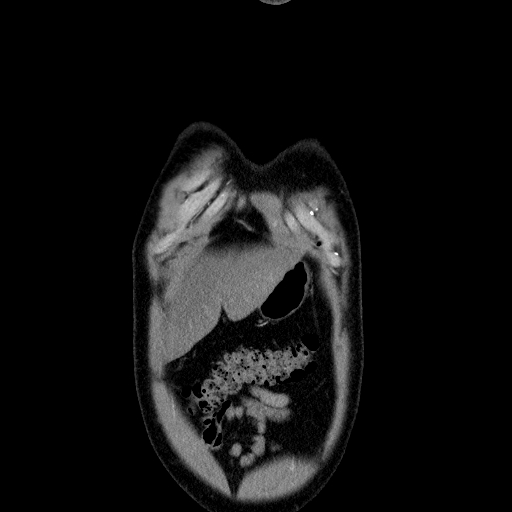File:Codominant double aortic arch (Radiopaedia 56012-62637 B 5).jpg