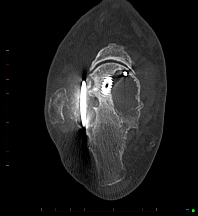 Collapsed total ankle replacement (Radiopaedia 17228-16932 Axial bone window 43).jpg