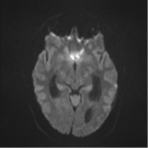 File:Colloid cyst (Radiopaedia 53164-59125 Axial DWI 39).png