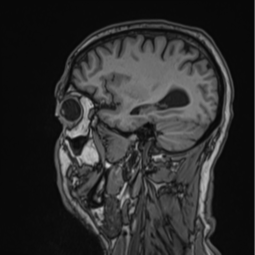 File:Colloid cyst of the third ventricle (Radiopaedia 86571-102662 Sagittal T1 22).png