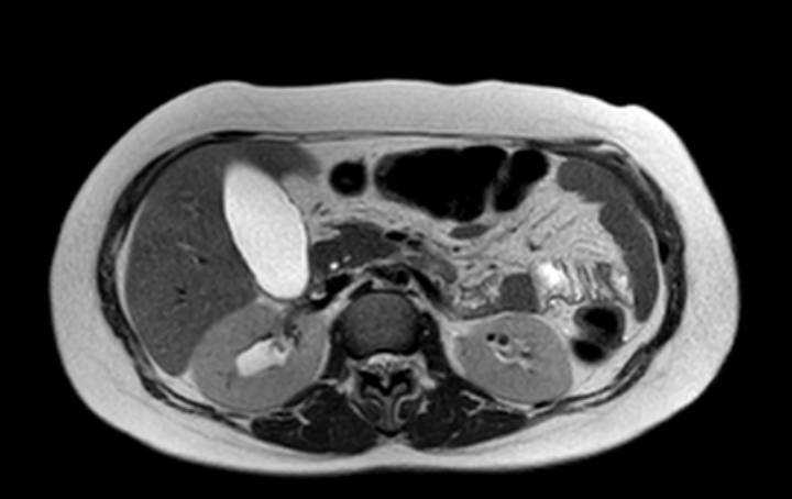 Colon adenocarcinoma with Krukenberg tumors, advanced pregnancy (Radiopaedia 67279-76645 Axial T2 54).jpg