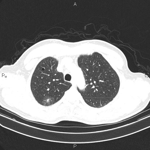 File:Colon cancer (Radiopaedia 85663-101443 Axial lung window 16).jpg