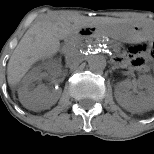 File:Colon cancer with calcified liver metastasis (Radiopaedia 74423-85309 Axial non-contrast 35).jpg