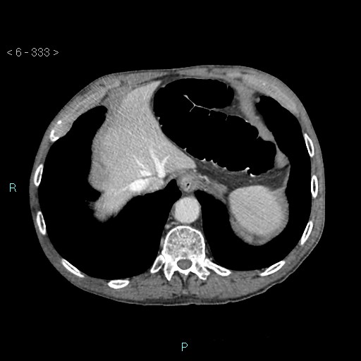 File:Colonic cancer (ultrasound and TC imaging) (Radiopaedia 50346-55713 B 333).jpg
