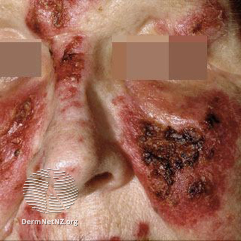 Cutaneous lupus erythematosus (DermNet NZ immune-lupus-erythematosus-2521).jpg
