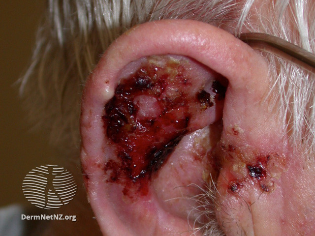Intraepidermal carcinoma (DermNet NZ lesions-scc-in-situ-2959).jpg