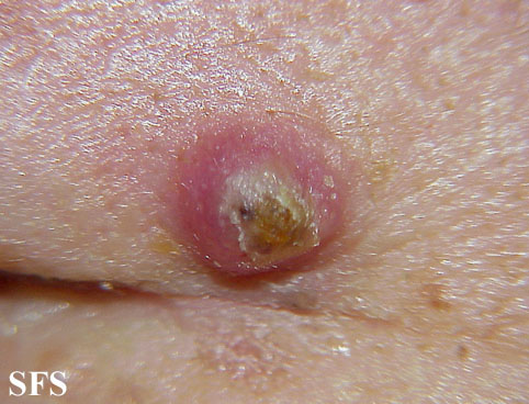 File:Keratoacanthoma (Dermatology Atlas 20).jpg