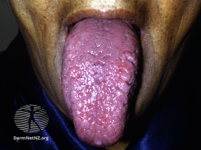 File:Macroglossia in systemic amyloidosis (DermNet NZ doctors-systemic-images-amyl1).jpg