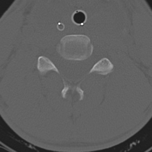 File:Multitrauma with diffuse axonal injury, temporal bone fractures and traumatic caroticocavernous fistula (Radiopaedia 37242-39035 Axial 173).png