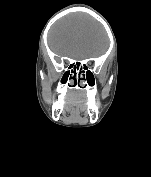 Nasal pyogenic granuloma (lobular capillary hemangioma) (Radiopaedia 85536-101244 Coronal non-contrast 95).jpg