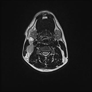 File:Nasopharyngeal carcinoma with perineural spread (Radiopaedia 55030-61380 Axial T2 52).jpg