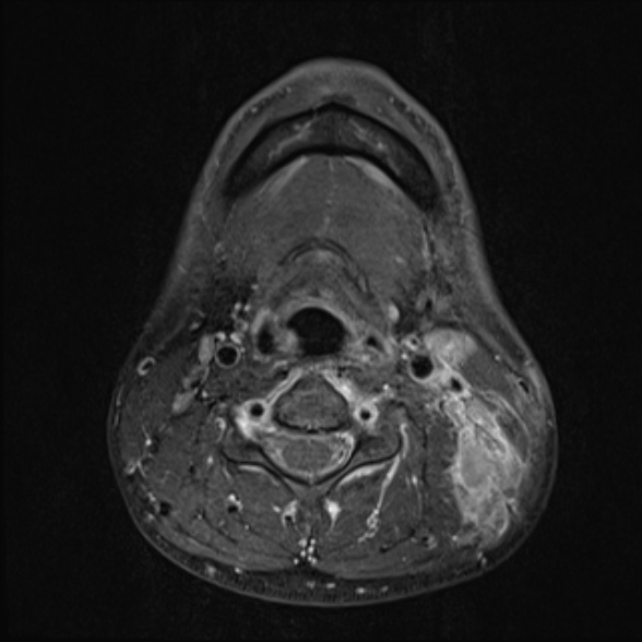 Nasopharyngeal carcinoma with skull base invasion (Radiopaedia 53415-59485 Axial T1 C+ fat sat 51).jpg
