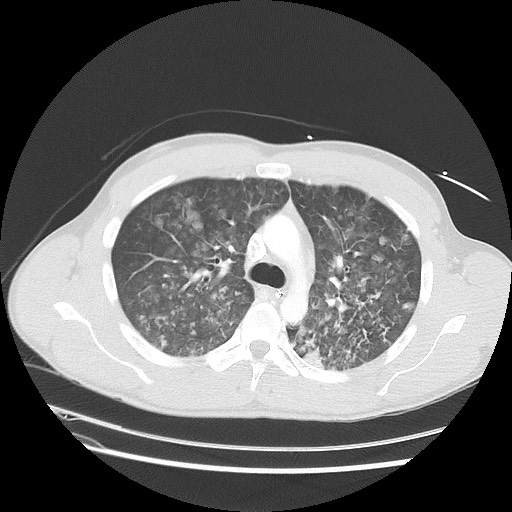 Near-drowning pulmonary edema (Radiopaedia 59457-66814 Axial lung window 20).jpg