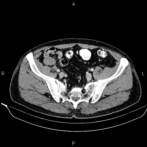 Necrotizing pancreatitis (Radiopaedia 87796-104249 A 45).jpg
