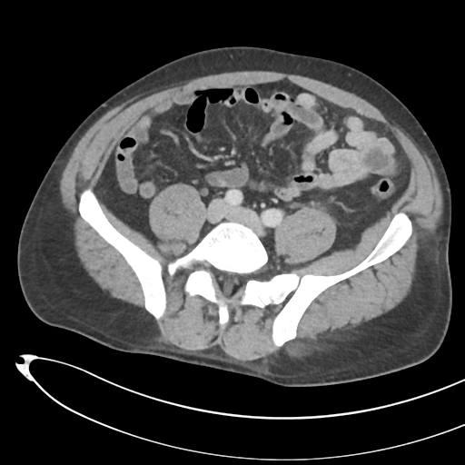 File:Necrotizing pancreatitis with acute necrotic collections (Radiopaedia 38829-41012 B 57).png