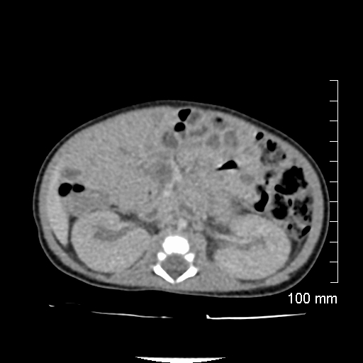 File:Neonatal neuroblastoma (Radiopaedia 56651-63438 Axial non-contrast 41).jpg