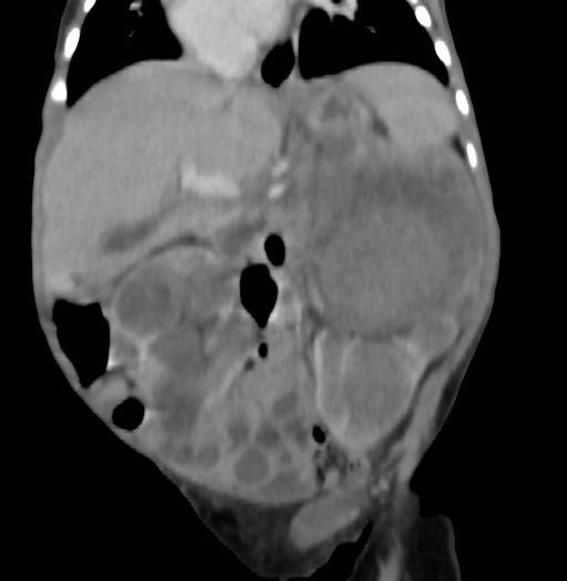 Nephroblastomatosis (Radiopaedia 71294-81607 B 181).jpg