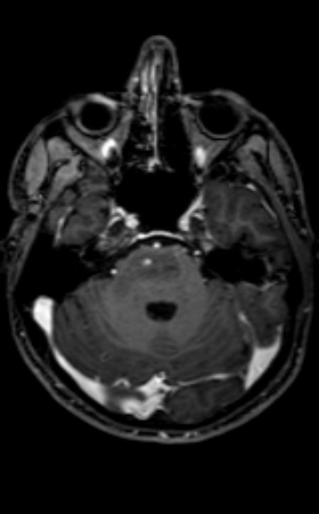 Neuro-Behçet disease (Radiopaedia 90112-107294 Axial T1 C+ 164).jpg