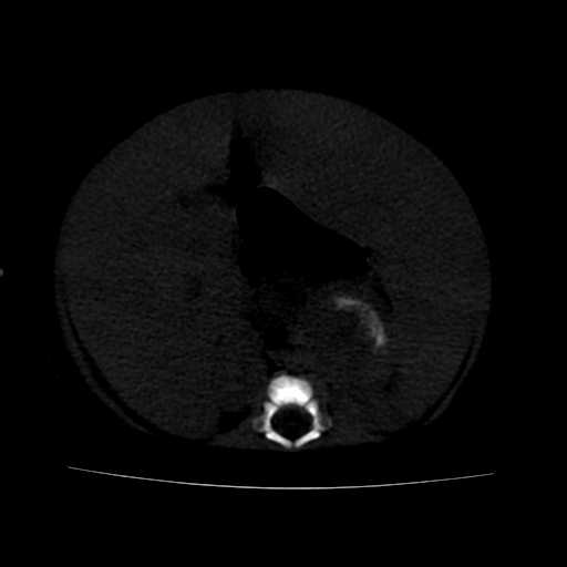 File:Neuroblastoma (Radiopaedia 20876-20799 Axial bone window 13).jpg
