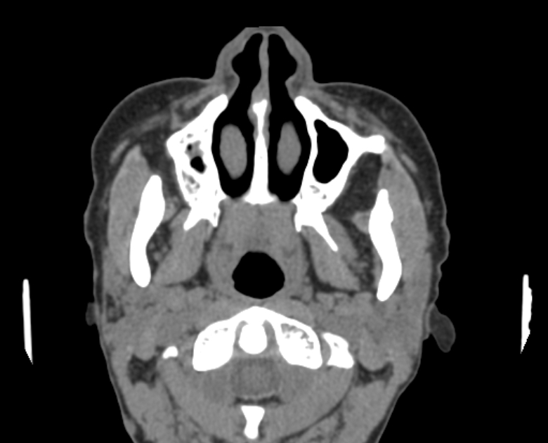 Neurofibromatosis type 1- orbital manifestations (Radiopaedia 49391-54511 Axial non-contrast 15).jpg