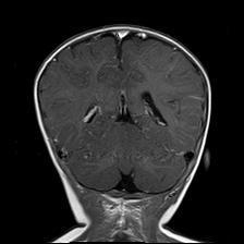 File:Neurofibromatosis type 1 (Radiopaedia 30089-30671 Coronal T1 C+ 21).jpg