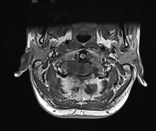 File:Neurofibromatosis type 1 (Radiopaedia 80355-93740 Axial T1 3).jpg