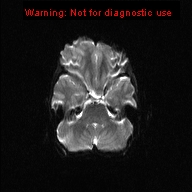 File:Neurofibromatosis type 1 with optic nerve glioma (Radiopaedia 16288-15965 Axial DWI 17).jpg