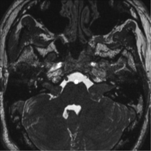 Neurofibromatosis type 2 (Radiopaedia 44936-48838 E 26).png